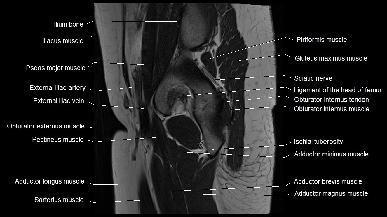 Hip sagittal cross sectional anatomy image 24.webp